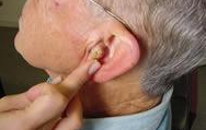 Adaptação dos aparelhos auditivos