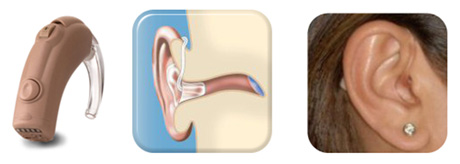 Estrutura básica do aparelho auditivo retroauricular analógica