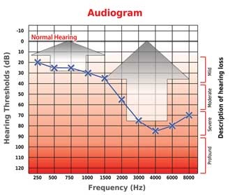 Aparelhos Auditivos Analógicos | Audioclean Aparelhos Auditivos