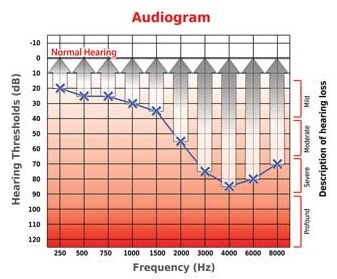 Aparelhos Auditivos Digitais | Audioclean Aparelhos Auditivos