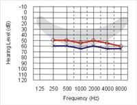 Perda Auditiva Moderada